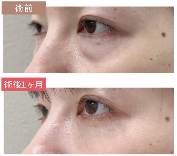 術前と術後１ヶ月の比較写真
