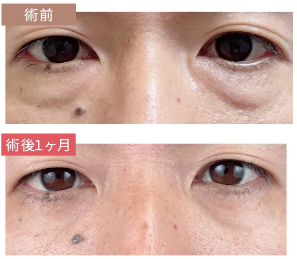 術前と術後１ヶ月の比較写真