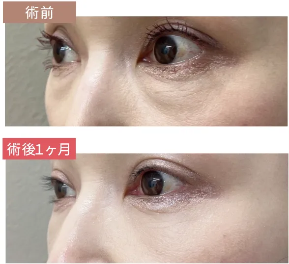 術前と術後１ヶ月の比較写真