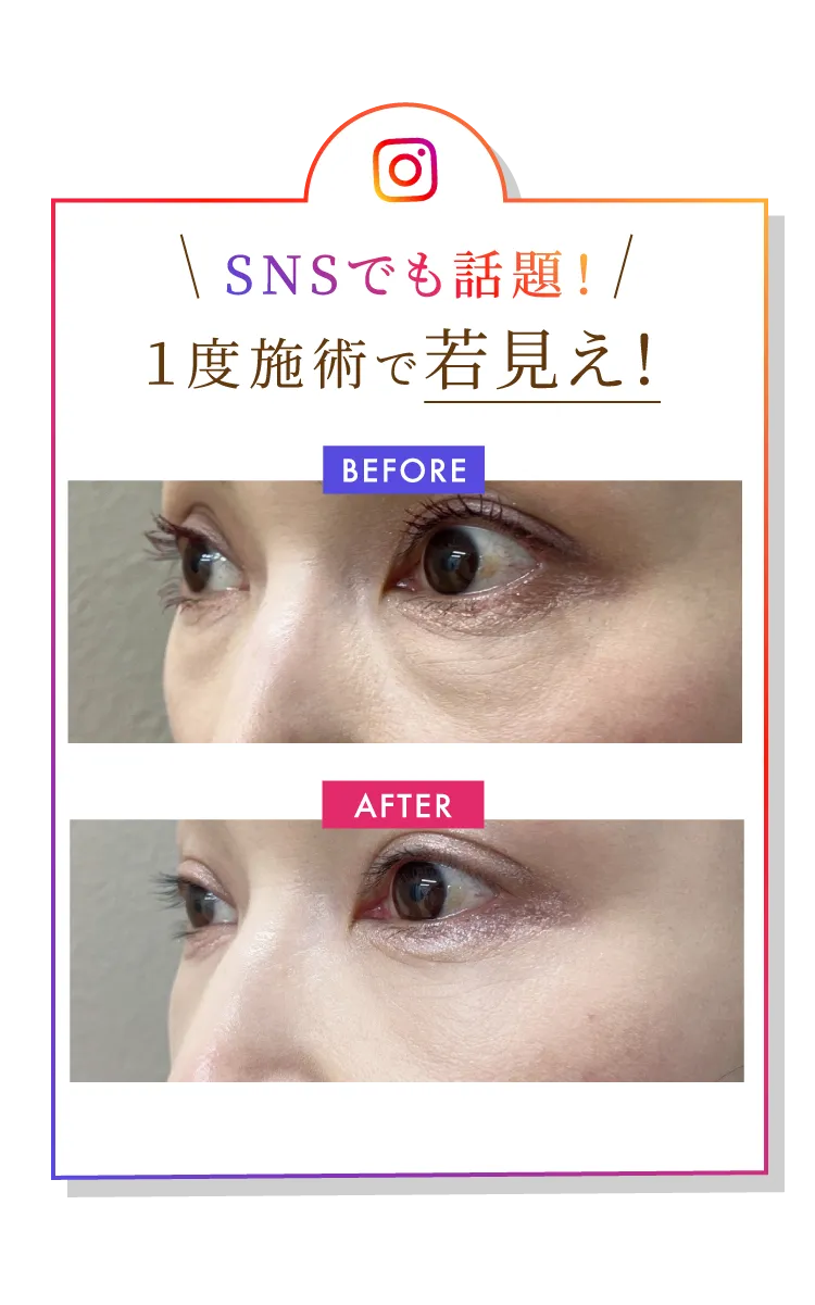 SNSでも話題！1度施術で若見え！