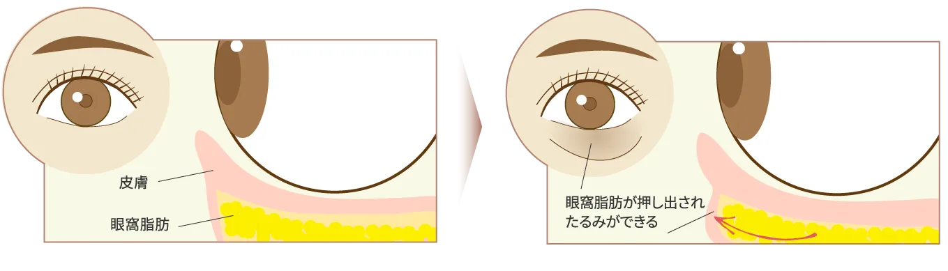 たるみの仕組み