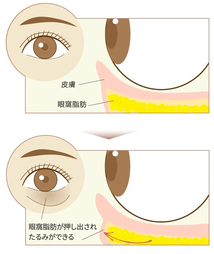 たるみの仕組み