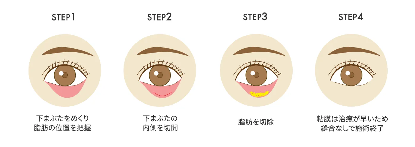 STEP1：下まぶたをめくり脂肪の位置を把握／STEP2：下まぶたの内側を切開／STEP3：脂肪を切除／STEP4：粘膜は治癒が早いため縫合なしで施術終了
