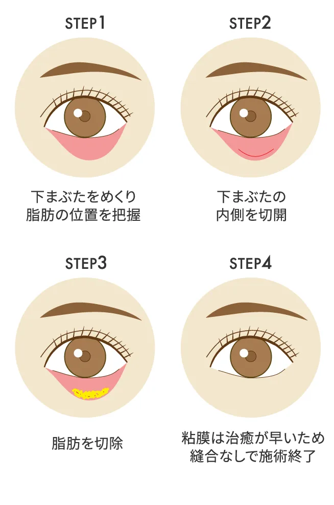 STEP1：下まぶたをめくり脂肪の位置を把握／STEP2：下まぶたの内側を切開／STEP3：脂肪を切除／STEP4：粘膜は治癒が早いため縫合なしで施術終了